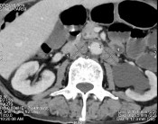 Hình C Hình ảnh chụp CT tại thời điểm kháng cắt tinh hoàn Bệnh nhân được 3