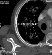 Hình C Hình ảnh chụp CT tại thời điểm kháng cắt tinh hoàn Bệnh nhân được 4