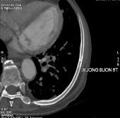 Hình C Hình ảnh chụp CT tại thời điểm kháng cắt tinh hoàn Bệnh nhân được 5