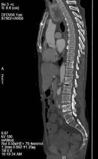 Hình C Hình ảnh chụp CT tại thời điểm kháng cắt tinh hoàn Bệnh nhân được 6