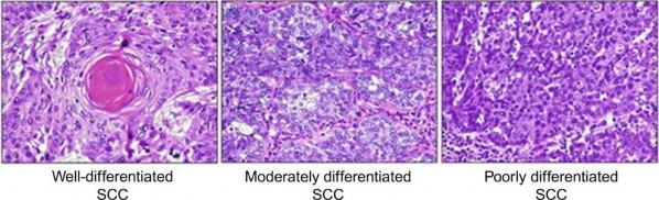 Hình 1 2 Hình ảnh vi thể UTBM vảy 35 Ung thư biểu mô tuyến chiếm khoảng 9 ung 1