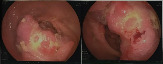 Kết quả Vị trí đại tràng gần góc gan có khối sùi lớn kích thước 3x4cm 1