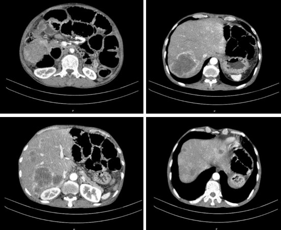 Kết quả Dày thành đại tràng góc gan trên đoạn dài 52mm vị trí dày nhất 17mm 2