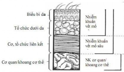 Hình 1 1 Sơ đồ phân loại nhiễm khuẩn vết mổ Nguồn Theo Bộ Y tế 2012 2 1 1 3 1