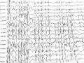 Điện Não Đồ Trong Cơn Ngưng Hành Vi: Phức Hợp Kịch Phát Nhọn-Sóng Chậm 2-3 Hz Kéo Dài 10 Giây (Bệnh Nhân Nguyễn Mai L. Trong Nghiên Cứu)
