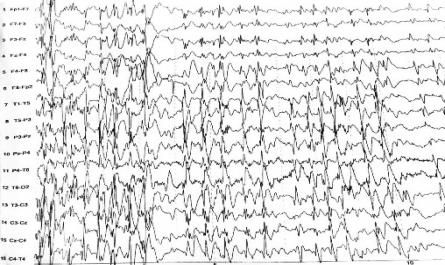 Điện Não Đồ Trong Cơn Ngưng Hành Vi: Phức Hợp Kịch Phát Nhọn-Sóng Chậm 2-3 Hz Kéo Dài 10 Giây