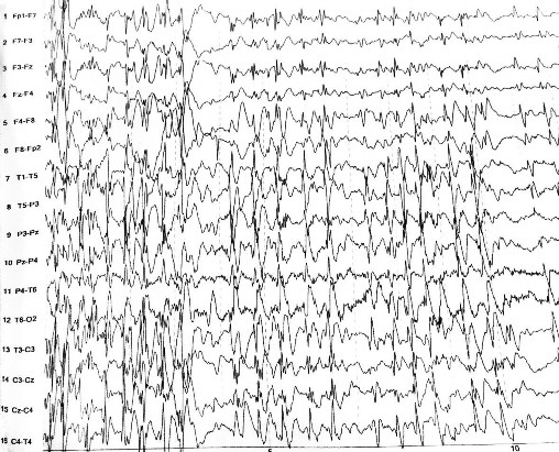 Hình 4 1 Điện não đồ trong cơn ngưng hành vi phức hợp kịch phát nhọn sóng 1