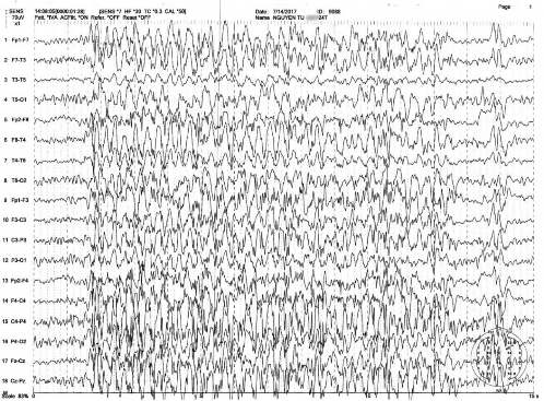 Hình 4 2 Điện não đồ trong cơn co giật toàn thân phức hợp kịch phát đa nhọn 2
