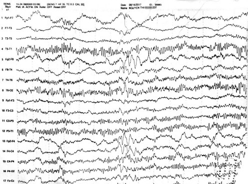 Hình 4 3 Điện não đồ ngoài cơn sóng chậm thành nhịp ngắt quãng tần số 3 4 Hz 3