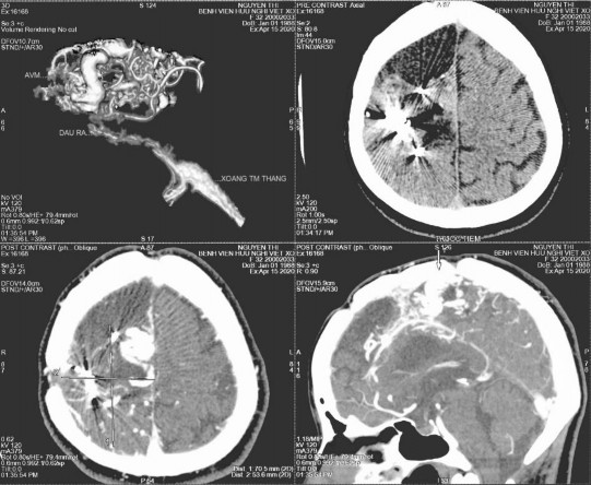 Hình 4 8 AVM bán cầu phải sau nút mạch 02 lần bệnh nhân Nguyễn Thị H trong 2