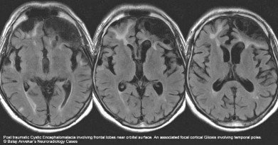 Hình 1 10 Tổn thương não sau chấn thương sọ não dạng nang dịch và tăng sinh 10