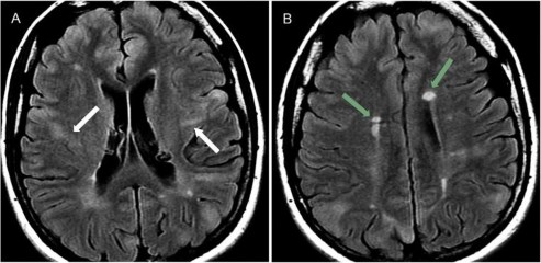 Hình 1 12 Các tổn thương não trong xơ cứng củ Tuberous sclerosis Nguồn trích dẫn 12