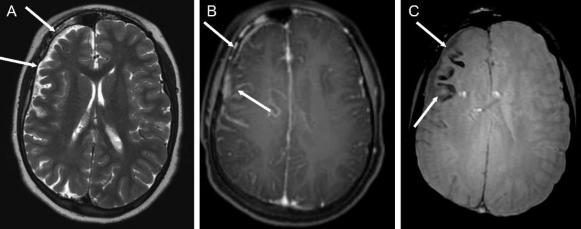 Hình 1 13 Tổn thương não trong hội chứng Sturge Weber Nguồn trích dẫn Hiba AH 13