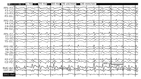 Hình 1 3 Kịch phát có chu kỳ toàn thể GPDs Nguồn trích dẫn Chong DJ Hirsch LJ J Clin 2