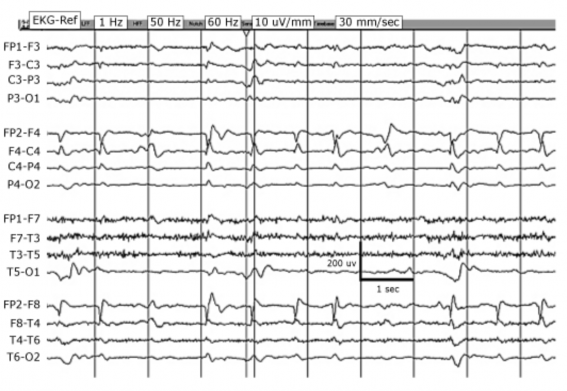 Hình 1 4 Kịch phát có chu kỳ một bên ở bên phải LPDs Nguồn trích dẫn Chong DJ 3