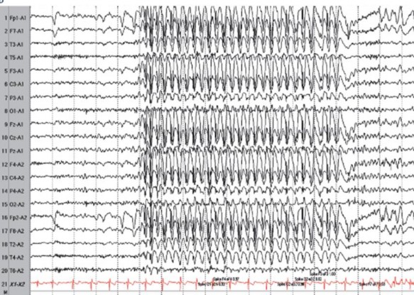 Hình 1 5 Điện não trong cơn động kinh co cứng co giật toàn thể Nguồn trích dẫn 4