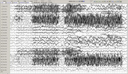 Hình 1 6 Điện não cơn động kinh cục bộ khởi phát thái dương trán bên phải 5