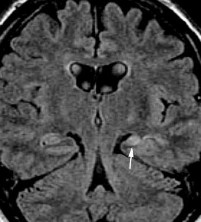 Hình 1 7 Xơ hóa hồi hải mã trái kèm teo thùy thái dương bên trái Nguồn trích 6