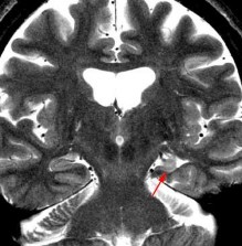 Hình 1 7 Xơ hóa hồi hải mã trái kèm teo thùy thái dương bên trái Nguồn trích 7