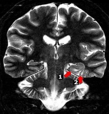 Hình 1 8 Loạn sản vỏ não khu trú hồi cạnh hải mã và hồi chẩm thái dương 8