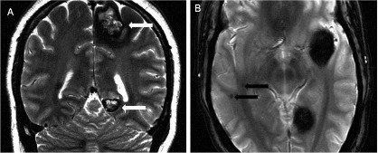 Hình 1 9 Dị dạng u mạch thể hang tính chất gia đình Nguồn trích dẫn Hiba AH 9