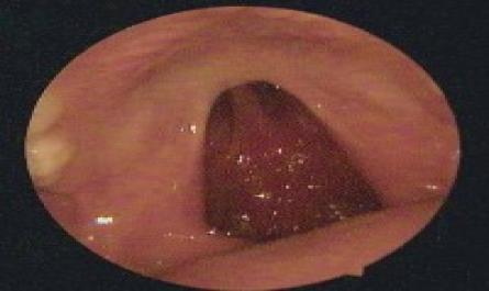 Đánh giá chức năng tai giữa trên bệnh nhân khe hở vòm miệng - 21