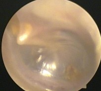 Ảnh 10 MN xẹp chưa chạm vào ụ nhô MSBA 1806217633 Ảnh 11 MN xẹp chạm vào khớp 10