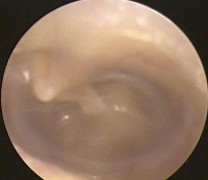 Ảnh 11 MN xẹp chạm vào khớp đe đạp MSBA 1806217173 Ảnh 12 MN dính vào ụ nhô 11