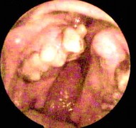 Ảnh 4 KHVM dạng D 2 bên MSBA 1806217649 Hình ảnh nội soi tai Ảnh 5 MN phồng trắng 4