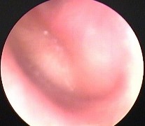 Ảnh 5 MN phồng trắng đục MSBA 1904282223 Ảnh 6 MN có mức dịch MSBA 1811255336 Ảnh 5