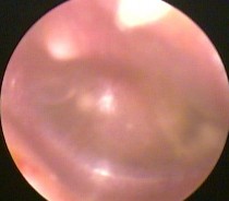 Ảnh 6 MN có mức dịch MSBA 1811255336 Ảnh 7 MN lõm trắng đục MSBA 1904282049 Ảnh 8 6