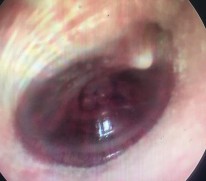 Ảnh 9 MN lõm xanh MSBA 1806217636 Ảnh 10 MN xẹp chưa chạm vào ụ nhô MSBA 1806217633 9