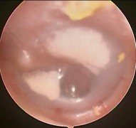 Ảnh 13 MN dày đục vôi hóa ứ dịch MSBA 1811254276 Ảnh 14 MN thủng MSBA 1906298068 1