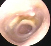 Ảnh 14 MN thủng MSBA 1906298068 Một số biến chứng Ảnh 15 MN chảy dịch MSBA 2