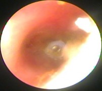 Ảnh 15 MN chảy dịch MSBA 1809239091 Ảnh 16 Màng nhĩ vôi hóa MSBA 1806217639 Ảnh 17 3