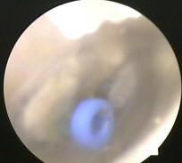 Ảnh 16 Màng nhĩ vôi hóa MSBA 1806217639 Ảnh 17 Nụ hạt trên màng nhĩ MSBA 1811254229 4