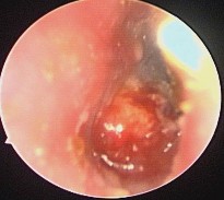 Ảnh 17 Nụ hạt trên màng nhĩ MSBA 1811254229 Ảnh 18 Còn lỗ thủng MSBA 1904282172 5