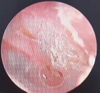 Ảnh 18 Còn lỗ thủng MSBA 1904282172 BỆNH ÁN MẪU Đề tài ĐÁNH GIÁ CHỨC NĂNG TAI 6