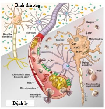 Hình 1 1 Sơ đồ minh họa hậu quả bệnh lý vi mạch và tế bào xảy ra trong tổn 1