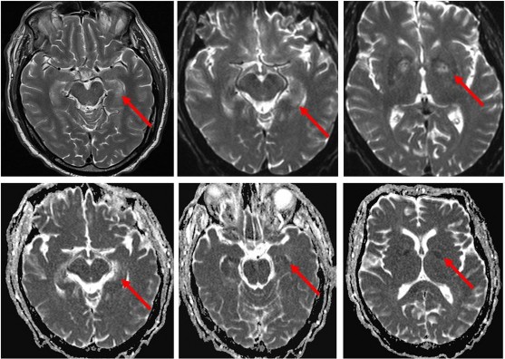Hình 1 2 Hình ảnh cộng hưởng từ tổn thương não do thiếu oxy ở hồi hải mã 2