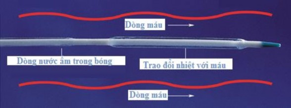 Hình 1 16 Cách làm lạnh hoặc làm ấm dòng máu trong cơ thể qua catheter 99 CHƯƠNG 2 5