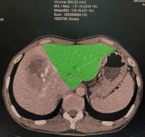 Hình 1 3 Thể tích gan trái bảo tồn đo bằng chụp X quang cắt lớp vi tính Nguồn 2