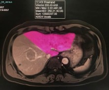 Hình 1 4 Thể tích gan trái bảo tồn đo bằng chụp cộng hưởng từ Nguồn Bệnh 3