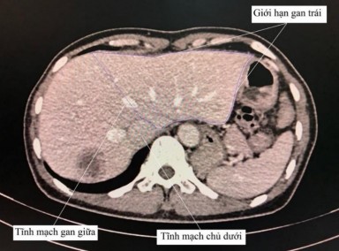 Hình 2 3 Cách xác định ranh giới gan trái khi đánh giá thể tích gan Nguồn Bệnh 2