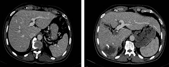 Hình 2 4 Gan trái trước 24 03 2020 và sau PVE 09 04 2020 BN A08 0021732 Hình 2 5 Gan trái 3