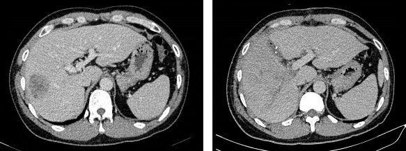 Hình 2 5 Gan trái trước 21 03 2019 và sau ALPPS thì một 09 04 2019 BN N19 0079221 2 6 3 4