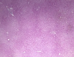 Hình 2 6 Tổn thương gan 0 6 theo Ishak BN N20 0227326 Hình 2 7 Tổn thương gan 1 6 theo 5