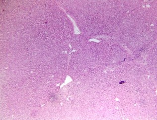 Hình 2 7 Tổn thương gan 1 6 theo Ishak BN N20 0180354 Hình 2 8 Tổn thương gan 2 6 theo 6