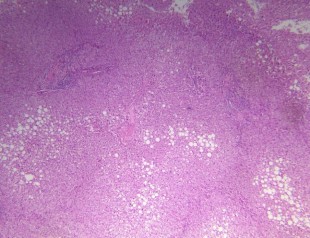 Hình 2 8 Tổn thương gan 2 6 theo Ishak BN N20 0194345 7