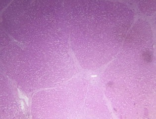 Hình 2 9 Tổn thương gan 3 6 theo Ishak BN N20 0204706 Hình 2 10 Tổn thương gan 4 6 theo 1